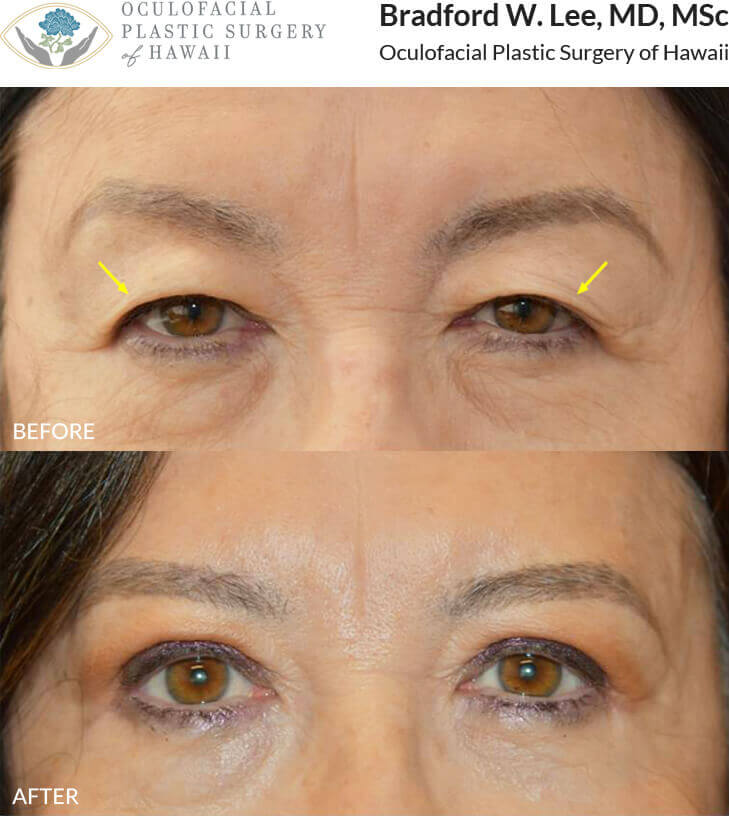 This 68-year-old patient presented with excess skin drooping over her upper eyelids, causing shadowing. She underwent an upper lid blepharoplasty to achieve a revitalized and refreshed look. *This photo was taken at 3 months post-op, and the mild residual redness/swelling on the upper lids will continue to resolve over time.*