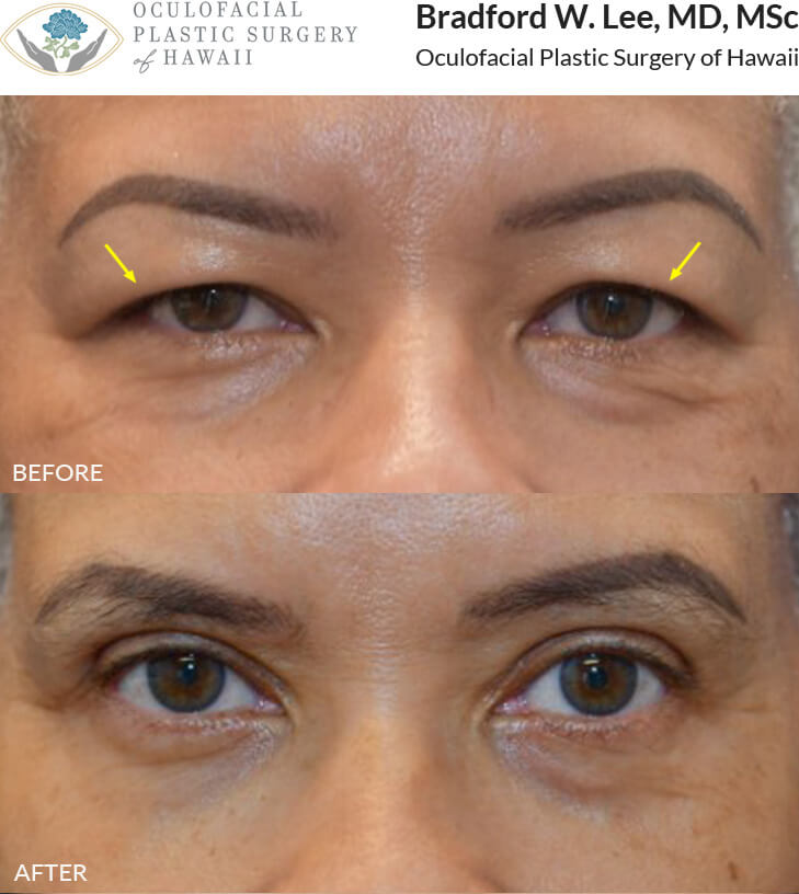 This lovely patient complained of the puffiness and drooping of her upper eyelids. She underwent an upper blepharoplasty to remove the excess skin and reshape the eyelids to achieve a harmonious and rejuvenated look.