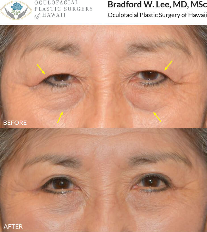 This 78-year-old lady complained of the excess skin resting on her eyelashes, causing visual impairment. She was also bothered by the puffiness of her lower eyelids. She underwent a bilateral upper and lower blepharoplasty for a natural but youthful enhancement of her upper and lower lids.