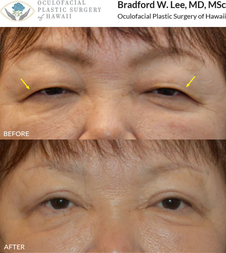 This 67-year-old patient complained of her eyelashes impairing her vision due to her droopy upper eyelids. She underwent an upper lid blepharoplasty to improve her vision and refresh her appearance. *This photo was taken at 3 months post-op, and the mild residual redness/swelling will continue to resolve over time.*