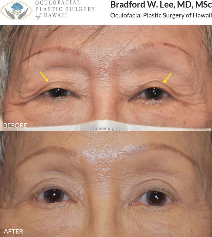 This 80+ year-old patient was bothered by excess skin on the upper lids and lateral hooding of skin. She underwent an upper blepharoplasty to remove excess skin, define the eyelid creases, and simultaneously open up her eyes.