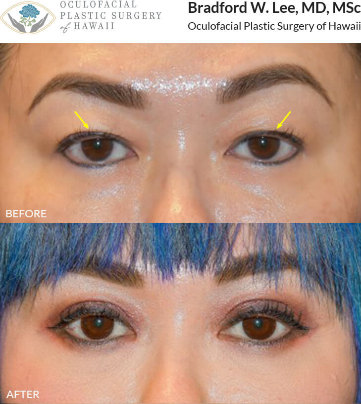 This lovely, young patient was noticing excess skin on her upper eyelids, difficulty seeing her eyelid crease, and the inability to do her eye makeup properly. She underwent an Asian blepharoplasty with the goal of making a higher, more prominent eyelid crease and being able to do her eye makeup to perfection!