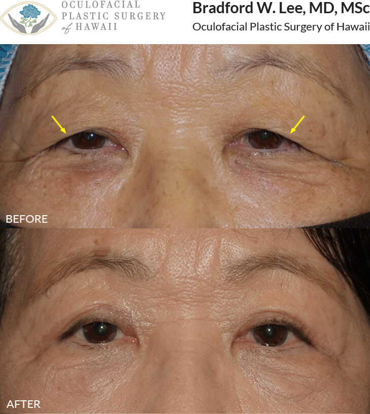 This 74-year-old female presented with significant excess skin and difficulty seeing peripherally. She underwent a upper lid blepharoplasty to improve her vision and remove the excess skin.