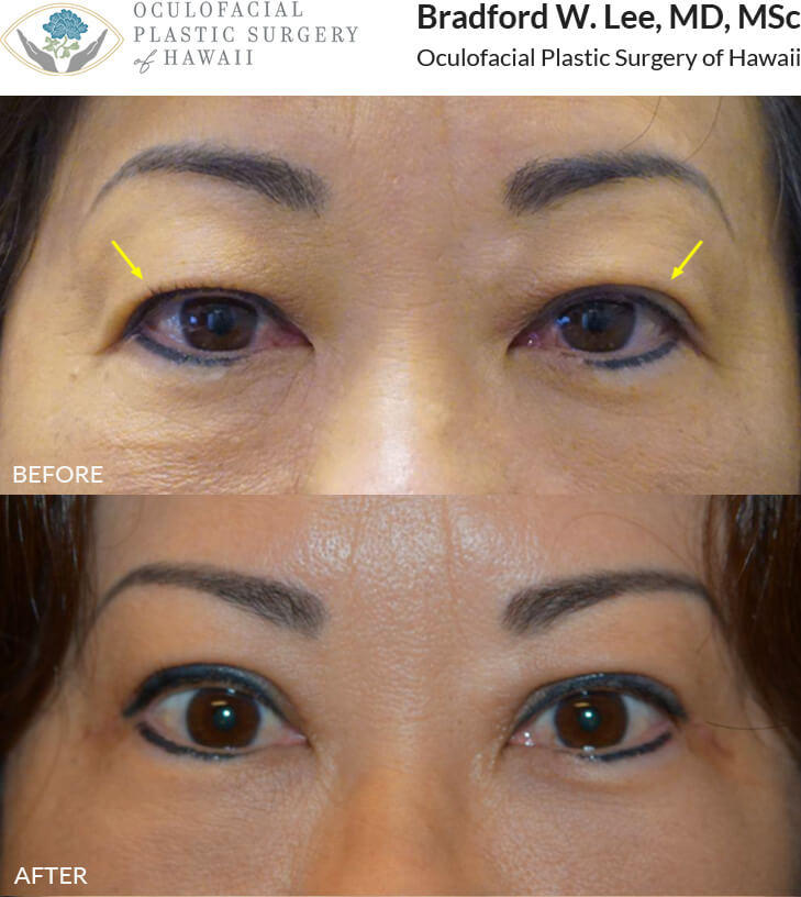 This 56-year-old patient complained of reduced peripheral vision due to her droopy upper eyelids. She underwent an upper lid blepharoplasty to improve her vision and achieve a rejuvenated and brighter look.