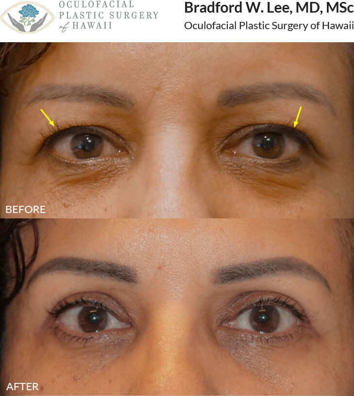 This patient in her 40’s was bothered by the hooded skin of her upper eyelids giving her a tired appearance.  She underwent an upper lid blepharoplasty surgery to remove the excess skin and give her eyes a more youthful and awake appearance.