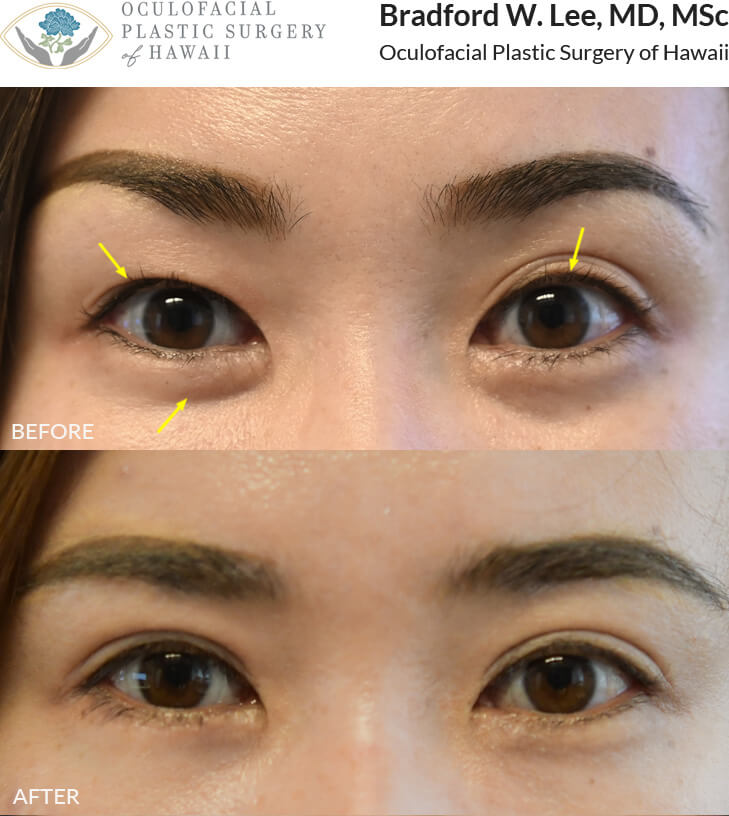 This 30-year-old female had a “suture method” double eyelid surgery done elsewhere. She was bothered by poor crease visibility on the right upper eyelid, multiple creases on the left upper eyelid, and puffiness of the right lower eyelid. She opted for a revision Asian double eyelid surgery to create well-defined creases on both sides, a right lower lid blepharoplasty to reduce excess puffiness, and a lateral canthoplasty to give her eyes a more almond-shaped appearance.