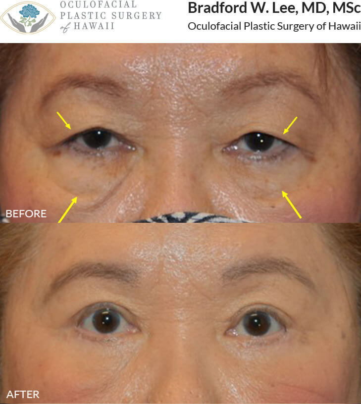 This 73-year-old patient complained of her vision being blocked by her droopy upper eyelids and wanted to address her under eye hollowing and “bags”. She underwent a quad blepharoplasty to remove the excess skin from her upper and lower eyelids with fat reposition to permanently fill in the tear troughs and get rid of her dark circles. *This photo was taken at 3 months post-op, and the mild residual redness/swelling on the upper lids will continue to resolve over time.*