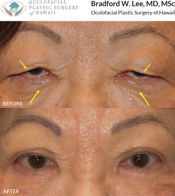 This 74-year-old lady presented with severe upper lid ptosis and excess skin of the upper and lower eyelids. She underwent an upper blepharoplasty with ptosis repair and lower blepharoplasty resulting in a dramatic yet natural-appearing enhancement of the upper and lower eyelids. *This photo was taken at 3 months post-op, and the mild residual redness/swelling will continue to resolve over time.*