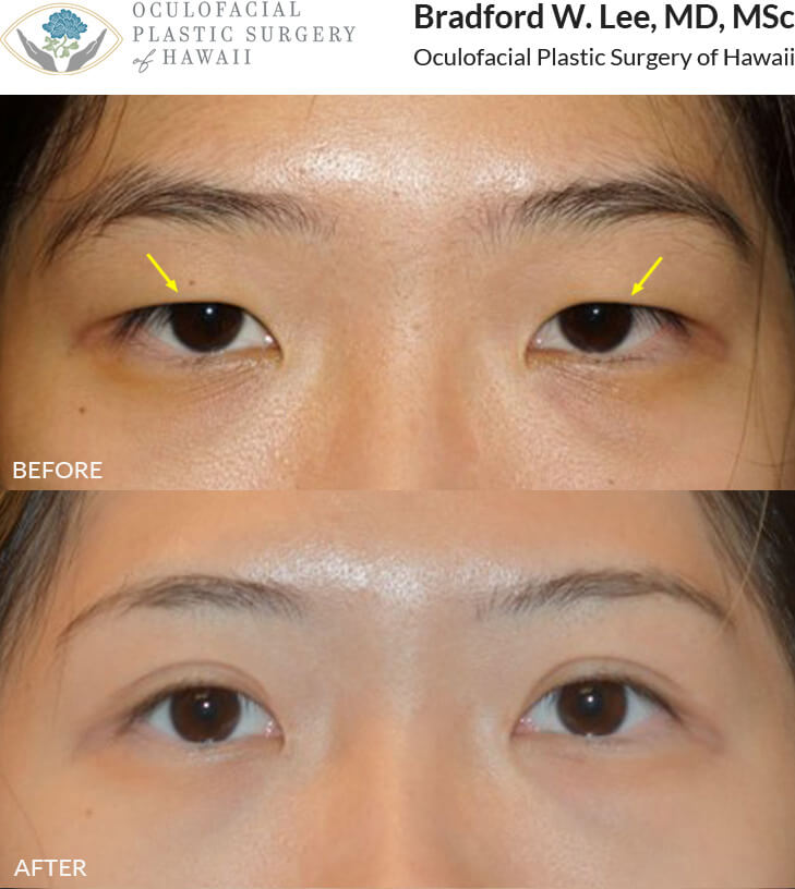 This 22-year-old patient was bothered by the size of her eyes, the lack of an upper eyelid crease, and prominent epicanthal folds. She underwent an Asian upper blepharoplasty and epicanthoplasty to create a natural eyelid crease and soften the epicanthal folds to show more of the white on the inner corner of her eyes.