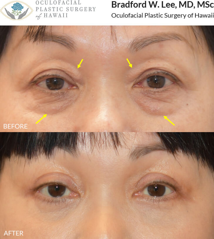 This female patient was interested in a more rejuvenated and refreshed appearance. She underwent a quad blepharoplasty with fat repositioning and skin pinch excision.  *This photo was taken at 3 months post-op, and the mild residual redness/swelling will continue to resolve over time.*