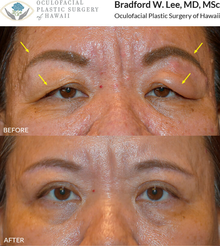 This 49-year-old female was bothered by the excess skin and heaviness of her brows. She underwent a upper blepharoplasty to remove the excess skin and a brow lift was performed to elevate the level of the brows. *This photo was taken at 3 months post-op, and the mild residual redness/swelling will continue to resolve over time.*