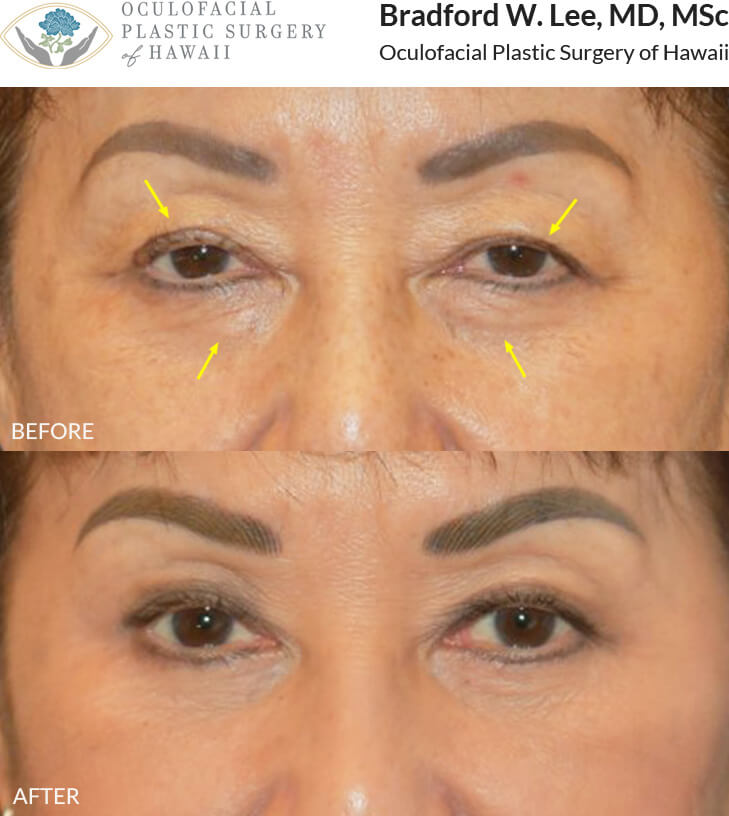 This patient was experiencing discomfort from the heaviness of her upper eyelids and was looking for a more youthful and refreshed appearance. She underwent a quad blepharoplasty and ptosis repair to address the droopiness and excess skin on her upper eyelids and under-eye “bags.”