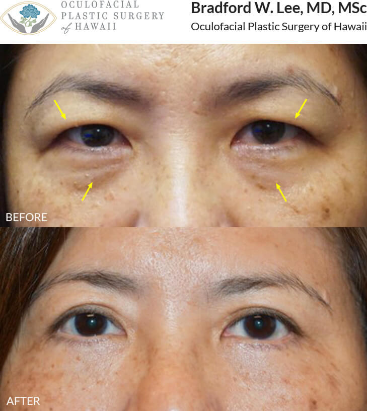 This 50+ year-old Asian lady was bothered by the puffiness of the upper lids, excess skin, and lack of a visible eyelid crease but wanted something very conservative and natural-looking.  She was also bothered by subtle fat prolapse, excess skin,  and hollowing along the lower eyelids.  She underwent an Asian upper blepharoplasty with lid crease formation and a fat-transposition lower blepharoplasty, resulting in a visible upper eyelid crease and refreshed appearance.