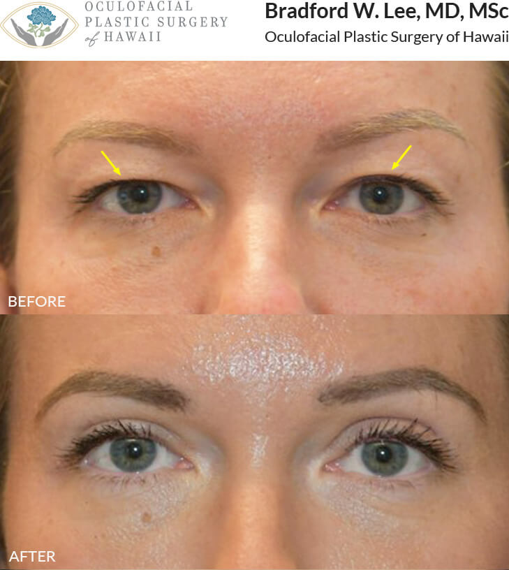 This 38-year-old patient was bothered by excess skin and hooding to the upper eyelids. She underwent a upper lid blepharoplasty to address the sagging skin and preserve a youthful yet natural appearance. She is now able to successfully apply her eye makeup.