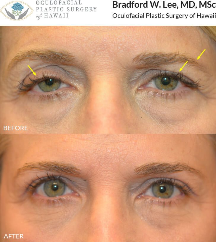 This 57-year-old patient presented with ptosis of the upper eyelids that made her look tired with an asymmetrical appearance.  She was also bothered by drooping of the left brow. This patient underwent a bilateral upper lid ptosis repair, upper blepharoplasty, and left brow ptosis repair to improve symmetry.