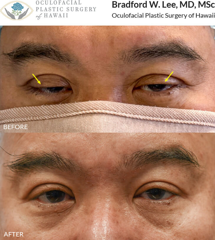 This 51-year-old male was bothered by significant drooping of the upper eyelids that were making it difficult to see.  He opted for a bilateral upper lid ptosis repair to lift his upper eyelids, allowing more light into the eye and improving his vision. *This photo was taken at 3 months post-op, and the mild residual redness/swelling will continue to resolve over time.*