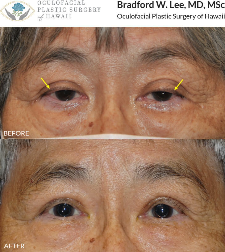 This 80-year-old lady presented with asymmetric ptosis of the upper eyelids and upper eyelid crease asymmetry that made her appear tired and sleepy. She underwent a bilateral upper lid ptosis repair resulting in brightening of her eyes and improvement in her peripheral vision.