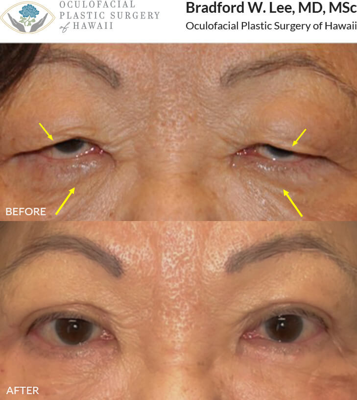 This 74-year-old lady presented with severe upper lid ptosis and excess skin of the upper and lower eyelids. She underwent an upper blepharoplasty with ptosis repair and lower blepharoplasty resulting in a dramatic yet natural-appearing enhancement of the upper and lower eyelids.  *This photo was taken at 3 months post-op, and the mild residual redness/swelling will continue to resolve over time.*