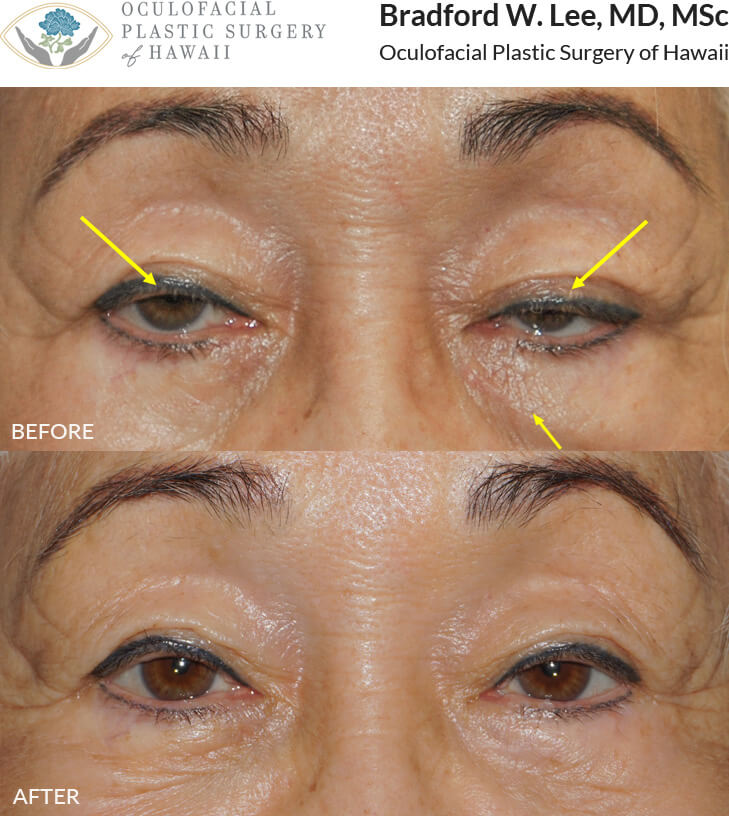 This 72-year-old lady presented with droopy upper eyelids and excess puffiness on the left lower eyelid. The patient underwent a conservative upper lid ptosis repair to open her eyes, and a left lower lid skin-pinch blepharoplasty with a dermal filler injection to the left tear trough region to improve her lower lid symmetry.