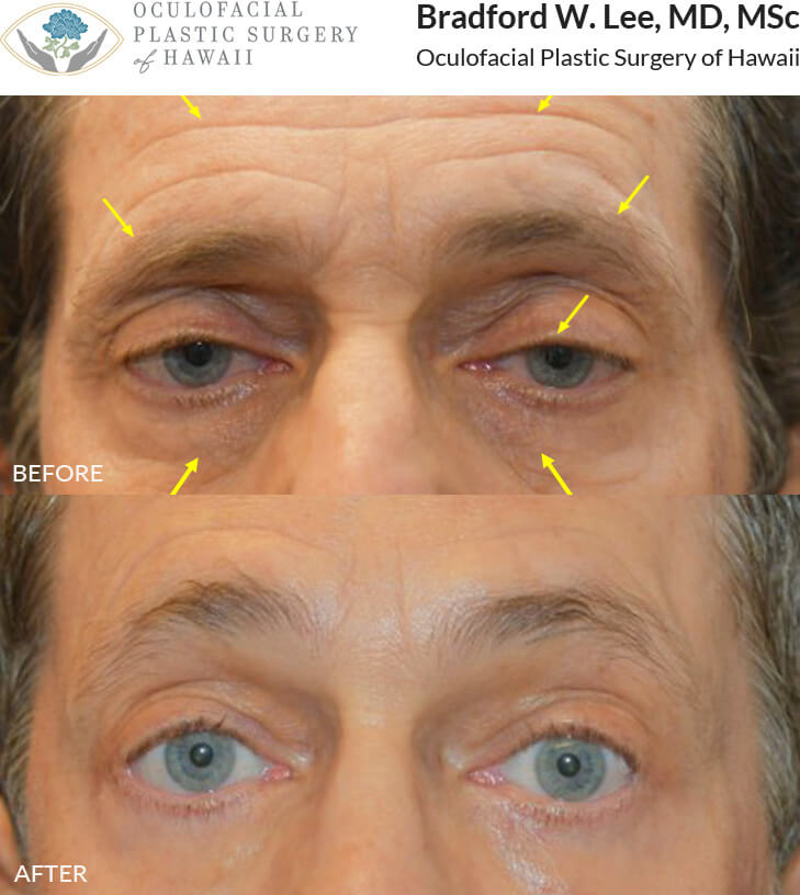 This 61-year-old patient presented with droopy upper eyelids and complained of looking “sleepy” all the time. The patient underwent a trichophytic brow lift with a ptosis repair and lower lid blepharoplasty to open up the eyelid complex for a brighter and more refreshed look.