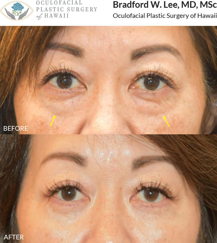 This beautiful patient in her 50’s complained of constantly looking tired. She underwent a lower lid blepharoplasty to tighten and rejuvenate the lower eyelid skin.