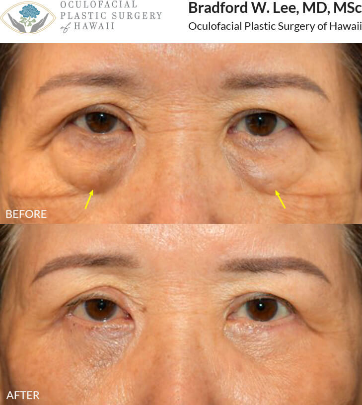 This 75 year-old patient was bothered by the puffiness of the lower lids. She underwent a lower lid blepharoplasty to remove the excess fat as well as fat reposition to achieve a smoother appearance of the under eye 