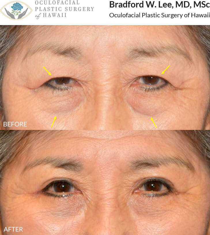 This 78-year-old lady complained of the excess skin resting on her eyelashes, causing visual impairment. She was also bothered by the puffiness of her lower eyelids. She underwent a bilateral upper and lower blepharoplasty for a natural but youthful enhancement of her upper and lower lids.