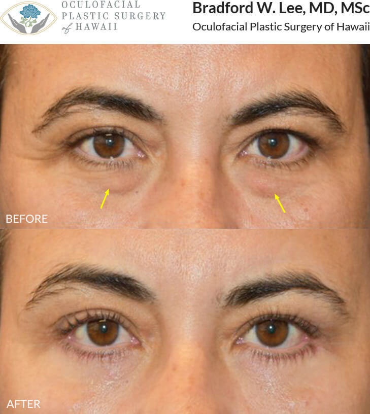 This 47-year-old lady complained of puffiness of the lower lids and under eye hollowing that extended into the cheeks. She underwent a lower lid blepharoplasty resulting in a natural but youthful enhancement of the lower lids.