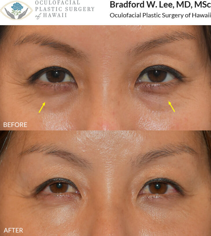 This young patient was starting to notice mild puffiness and hollowing to the lower eyelids. She underwent a lower lid blepharoplasty to smooth out her lower eyelid contour and reduce the appearance of shadowing.