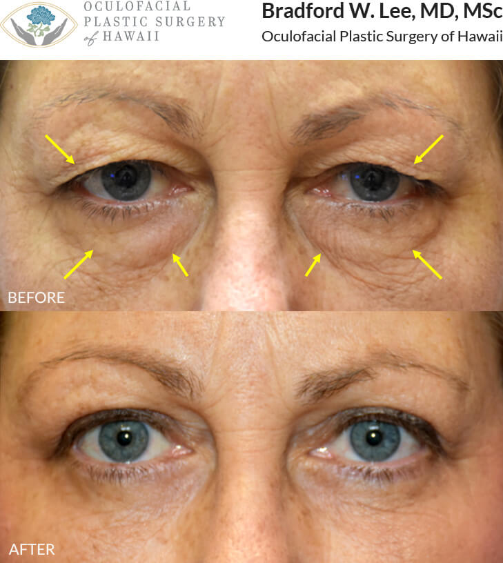 This 51-year-old lady complained of the excess skin that was resting on her eyelashes and preventing her from applying eye makeup. She was also bothered by the puffiness and skin textural changes of the lower eyelids. She underwent an upper and lower blepharoplasty for a dramatic yet natural-appearing enhancement of the upper and lower eyelids.