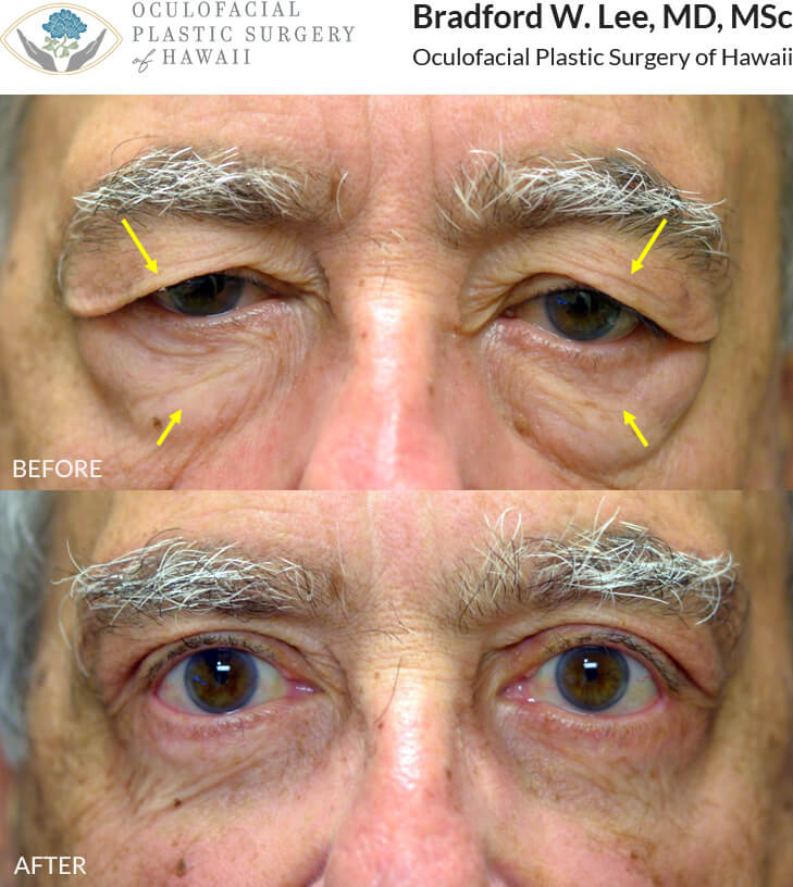 This 76-year-old male was bothered by lateral drooping of the eyebrows, excess upper eyelid skin, and prominent fat prolapse on the lower eyelids. He underwent a lateral brow lift and quad blepharoplasty for a dramatic yet natural-appearing improvement of the entire periocular region.