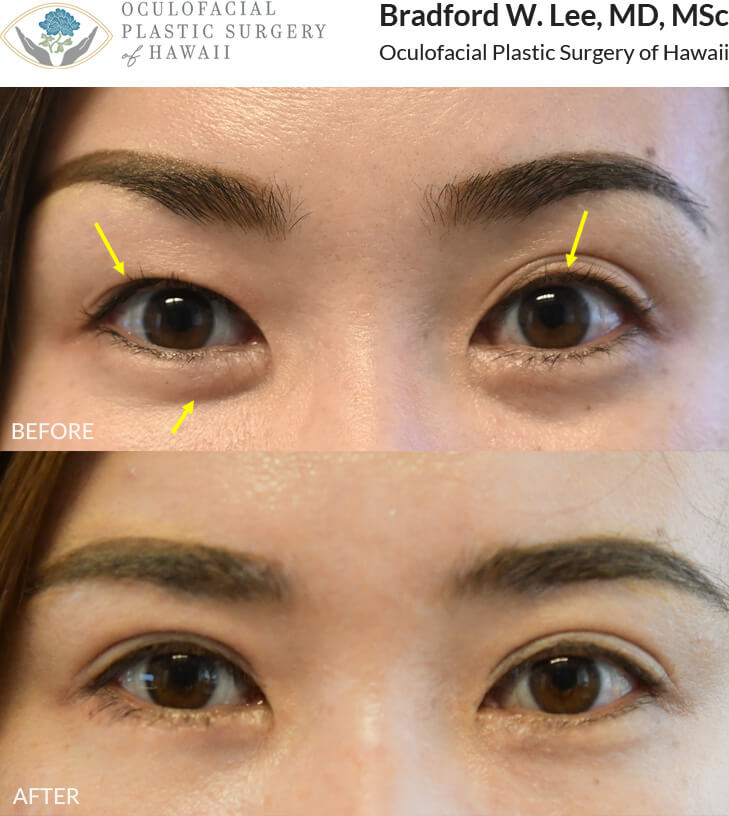 This 30-year-old female had a “suture method” double eyelid surgery done elsewhere. She was bothered by poor crease visibility on the right upper eyelid, multiple creases on the left upper eyelid, and puffiness of the right lower eyelid. She opted for a revision Asian double eyelid surgery to create well-defined creases on both sides, a right lower lid blepharoplasty to reduce excess puffiness, and a lateral canthoplasty to give her eyes a more almond-shaped appearance.