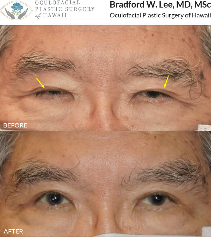 This 73-year-old patient was bothered by the drooping and heaviness of his upper eyelids. He underwent an upper lid blepharoplasty with a ptosis repair to improve his vision and quality of life. Results shown are 7 weeks after surgery.