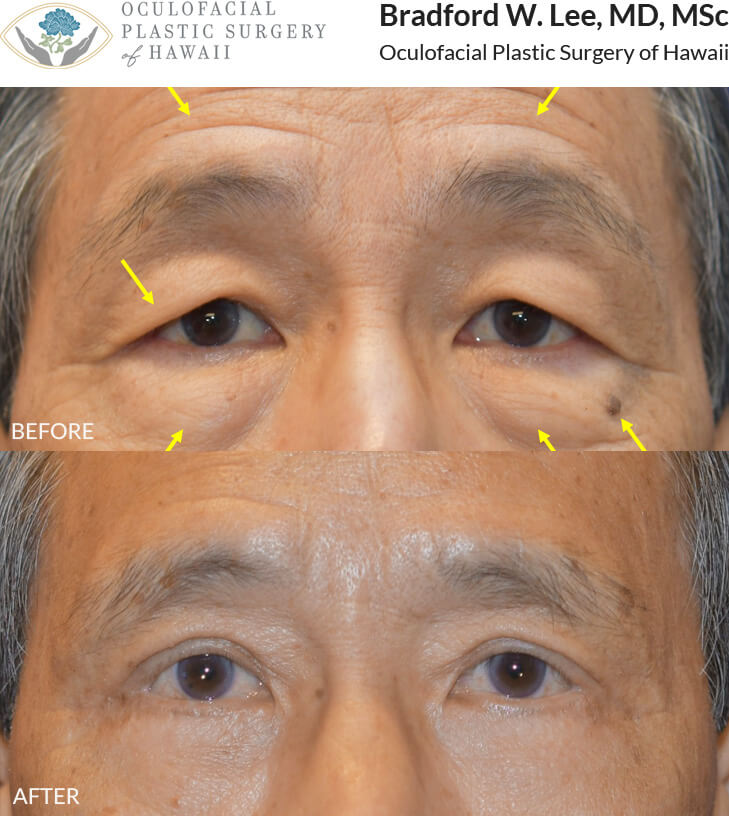 This 71-year-old male was bothered by the heaviness of his brows, excess skin on the upper eyelids, 