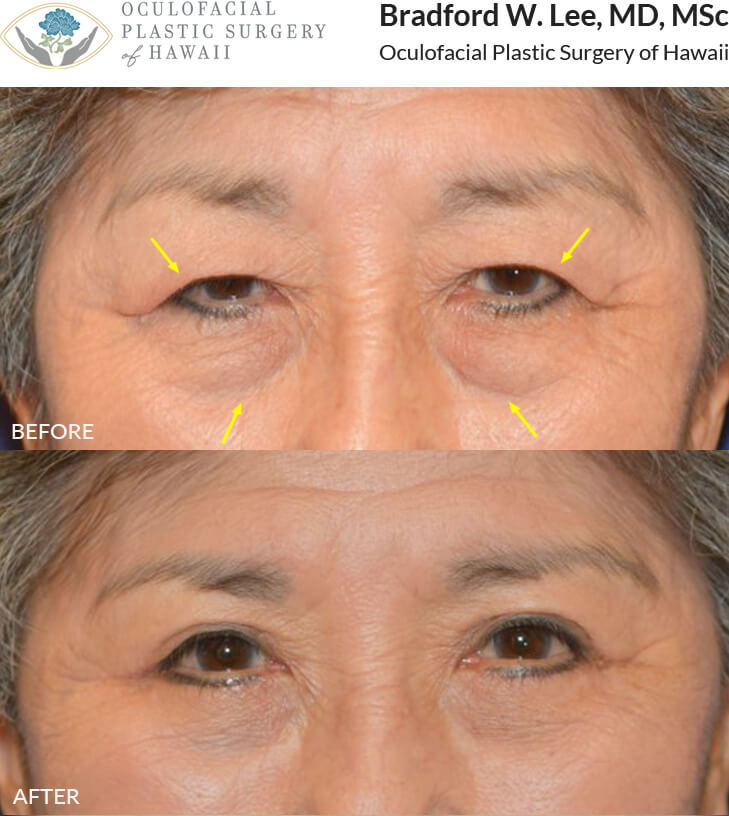 This 78-year-old lady complained of the excess skin resting on her eyelashes, causing visual impairment. She was also bothered by the puffiness of her lower eyelids. She underwent a bilateral upper and lower blepharoplasty for a natural but youthful enhancement of her upper and lower lids.