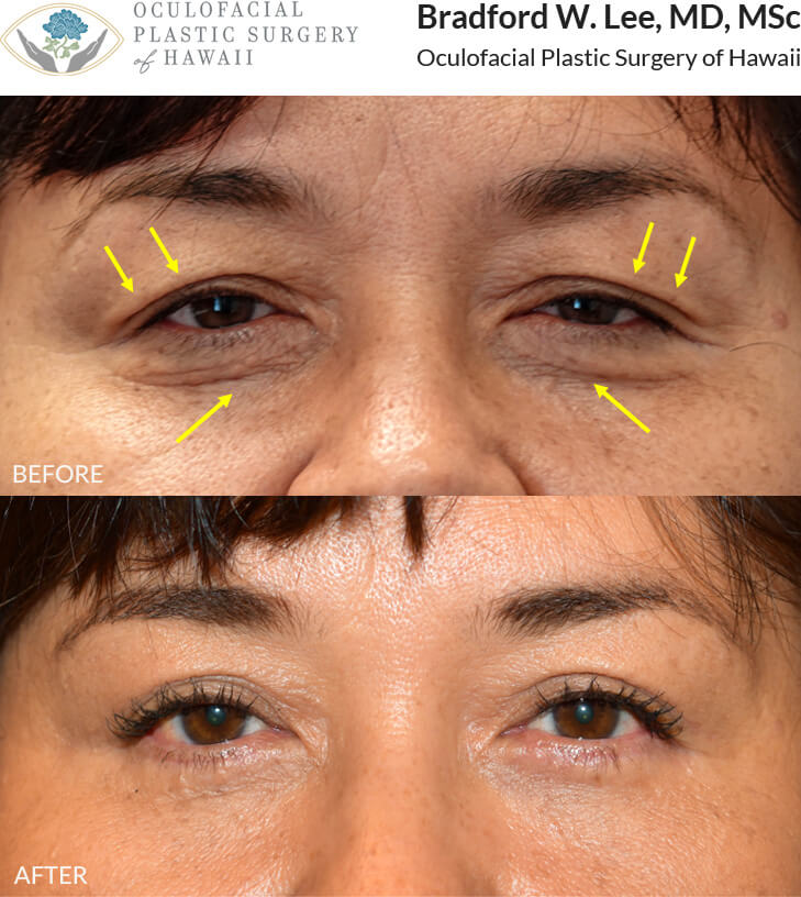 This 58-year-old female complained of excess skin on the upper and lower lids as well as droopiness that made her appear tired. She underwent an upper and lower lid blepharoplasty with a conservative ptosis repair to give her a refreshed and youthful appearance.