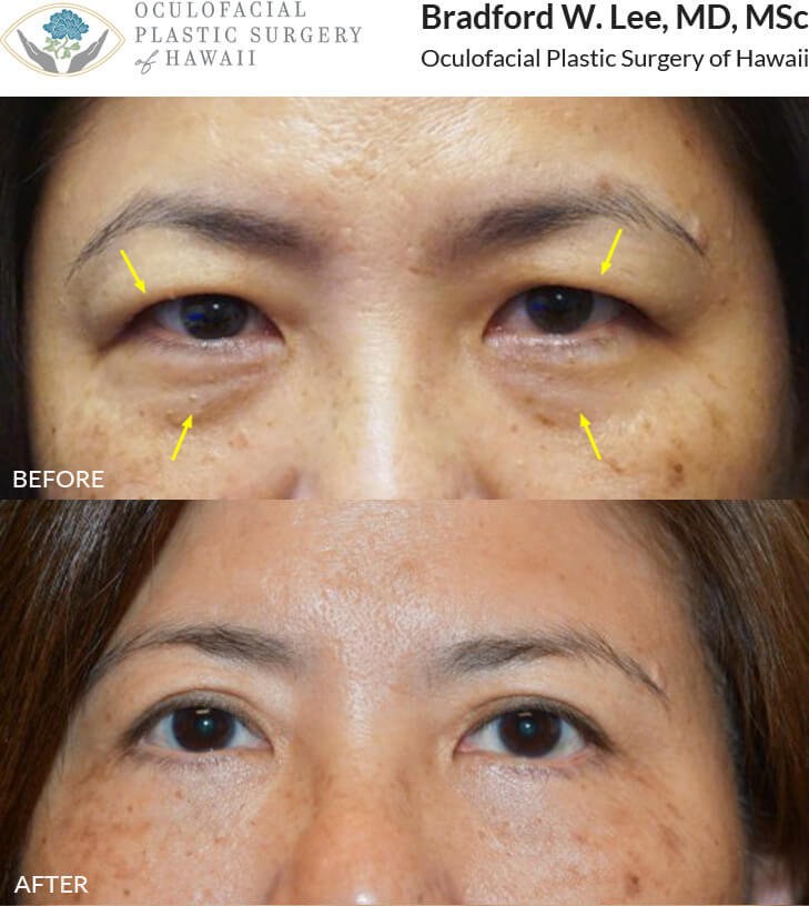 This 50+ year-old patient was bothered by puffiness of the upper lids, excess skin, and lack of a visible eyelid crease but wanted something very conservative and natural-looking. She was also bothered by subtle fat prolapse, excess skin, and tear trough hollowing along the lower lids. She underwent an Asian upper blepharoplasty with lid crease formation and a fat-transposition lower blepharoplasty resulting in a visible upper eyelid crease and refreshed appearance for the upper and lower lids.