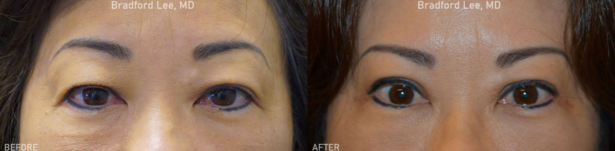 This 56-year-old patient complained of reduced peripheral vision due to her droopy upper eyelids. She underwent an upper lid blepharoplasty to improve her vision and achieve a rejuvenated and brighter look.
