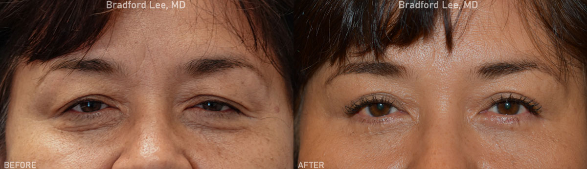 This 58-year-old female complained of excess skin on the upper and lower lids as well as droopiness that made her appear tired. She underwent an upper and lower lid blepharoplasty with a conservative ptosis repair to give her a refreshed and youthful appearance.