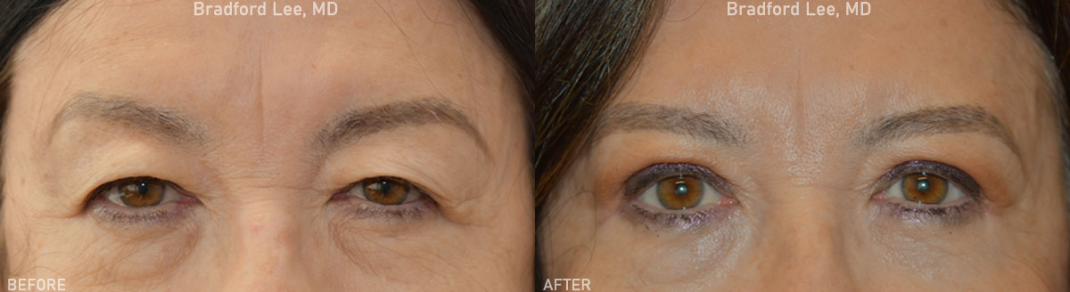 This 68-year-old patient presented with excess skin drooping over her upper eyelids, causing shadowing. She underwent an upper lid blepharoplasty to achieve a revitalized and refreshed look. *This photo was taken at 3 months post-op, and the mild residual redness/swelling on the upper lids will continue to resolve over time.*