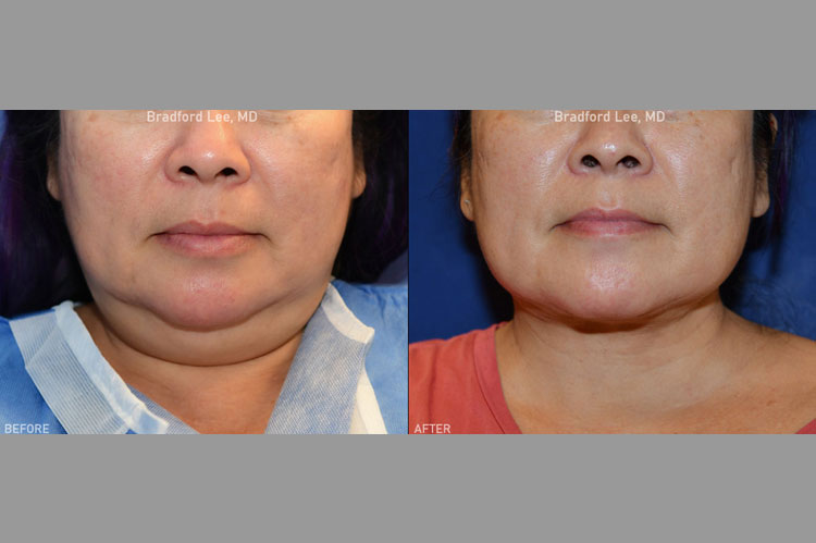 This patient was bothered by the fatty tissue in her neck causing a “double chin.” We performed neck liposuction and precise-meticulous surgical fat removal, resulting in a more sculpted neck and jawline.
