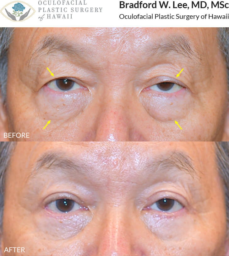 This patient was bothered by the drooping of his upper eyelids and the puffiness of the lower eyelids. He underwent an upper and lower (quad) blepharoplasty with a ptosis repair to remove the excess skin and fat on the eyelids and improve his vision.