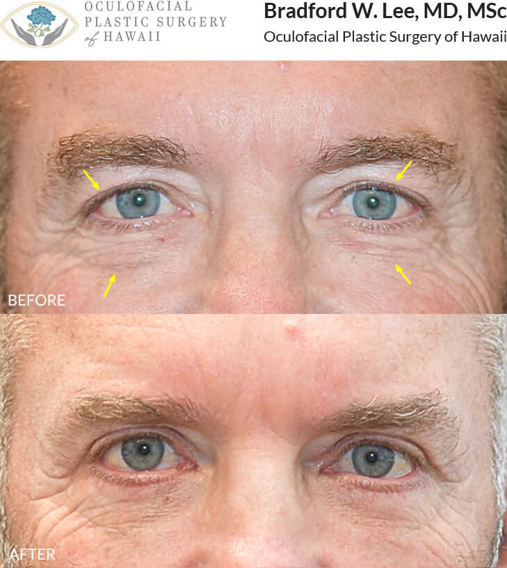 This patient was bothered by the excess skin on his upper and lower eyelids, opting for an upper and lower (quad) blepharoplasty to refresh his appearance.