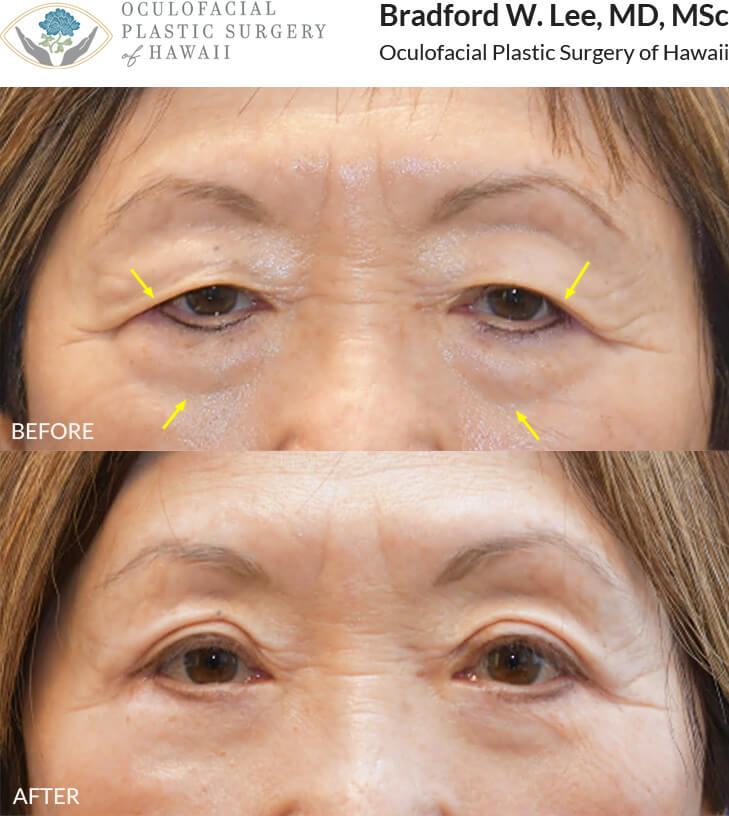 This patient was bothered by the heaviness of her upper and lower eyelids and noticed that her vision was being impaired. She underwent an upper and lower (quad) blepharoplasty to improve her vision and refresh her appearance.