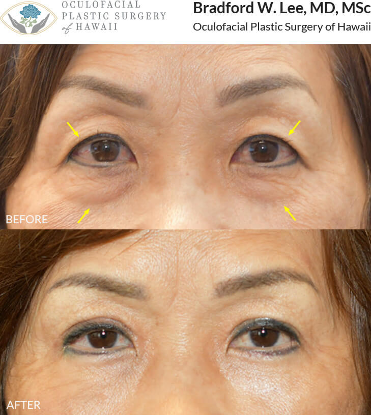 This patient was concerned about the puffiness of her upper and lower eyelids and opted for an upper and lower blepharoplasty (quad blepharoplasty) to remove the excess skin and fat, giving her a more refreshed and youthful appearance.