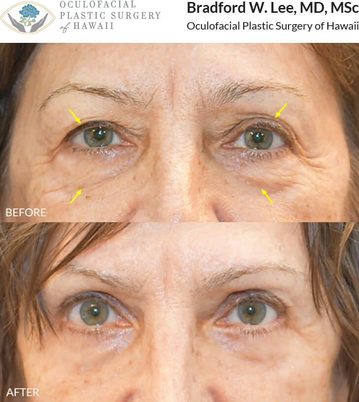 This patient was looking to refresh her overall appearance and chose to undergo a bilateral upper and lower blepharoplasty with a ptosis repair to the right upper eyelid, to remove excess skin and fat, restoring her youthful glow.