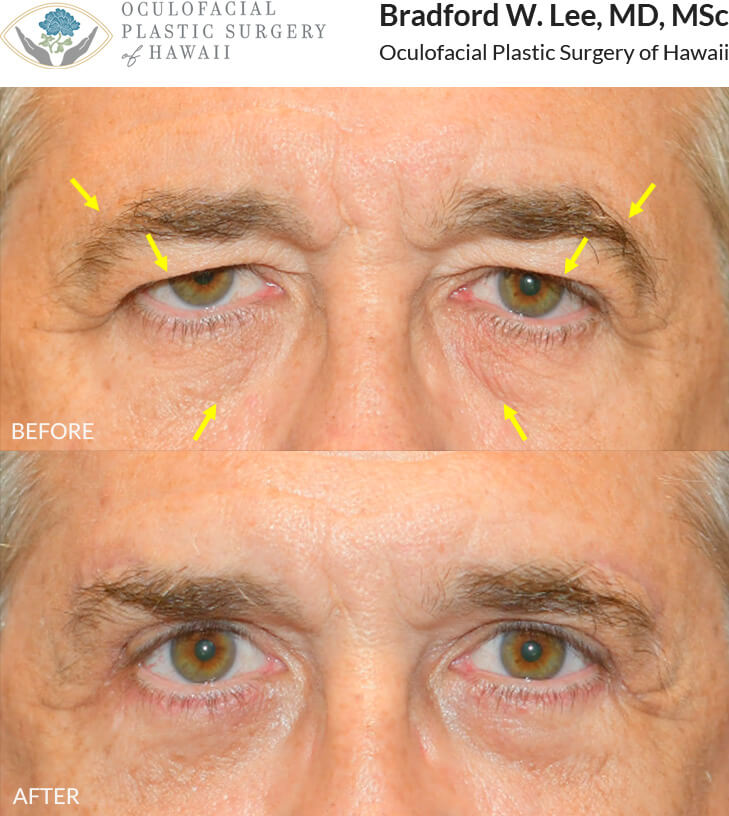 This patient was bothered by the heaviness of his upper eyelids and felt that he needed to raise his brows in order to see better. He underwent and upper and lower (quad) blepharoplasty to remove the excess skin on his upper and lower eyelids to improve his vision and refresh his appearance.