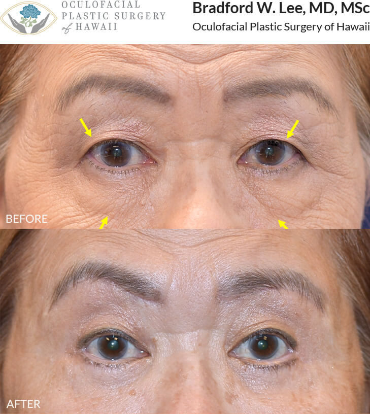 This patient was bothered by the excess skin on her upper and felt that it was weighing down her brows. She underwent an upper and lower (quad) blepharoplasty to remove the excess skin and fat on the eyelids and refresh her appearance.