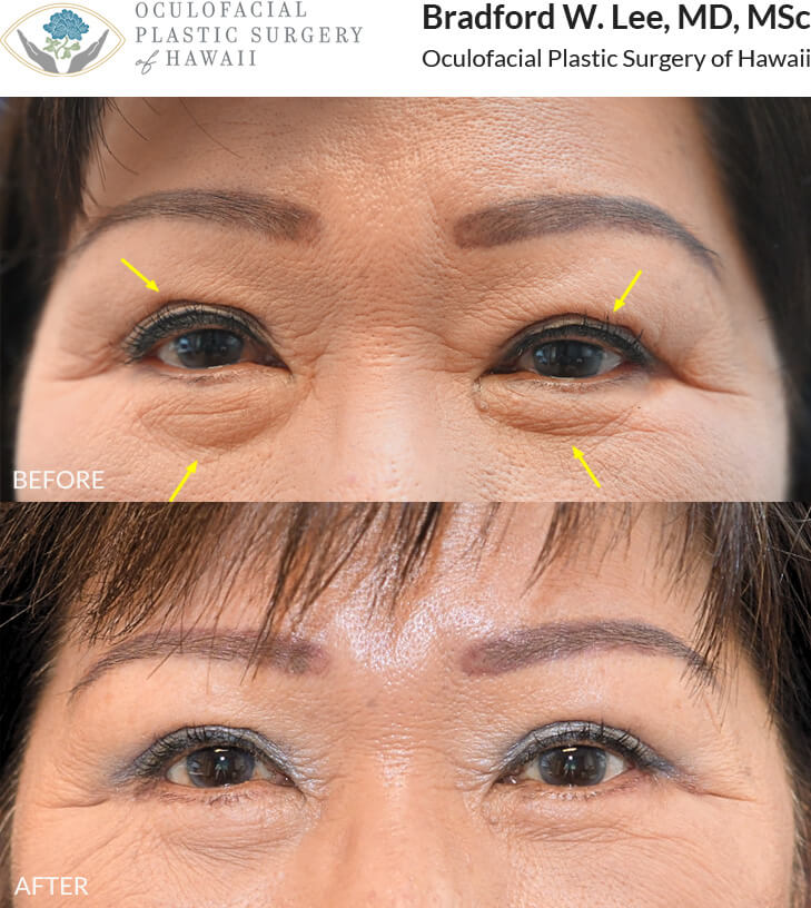 This patient previously had eyelid surgery done elsewhere but felt her eyelid creases were appearing a little irregular and uneven. She underwent a revision upper and lower (quad) blepharoplasty with an ectropion repair to the right lower eyelid to address her concerns and restore her natural beauty.