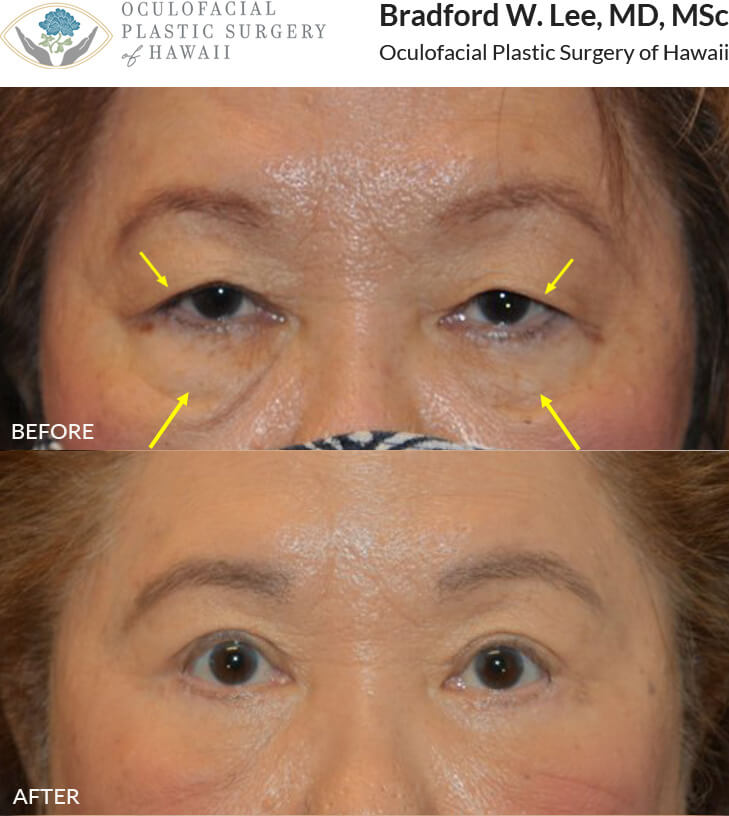 This 73-year-old patient complained of her vision being blocked by her droopy upper eyelids and wanted to address her under eye hollowing and “bags”. She underwent a quad blepharoplasty to remove the excess skin from her upper and lower eyelids with fat reposition to permanently fill in the tear troughs and get rid of her dark circles. *This photo was taken at 3 months post-op, and the mild residual redness/swelling on the upper lids will continue to resolve over time.*